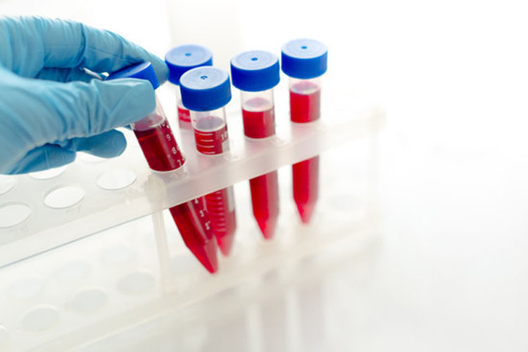 La EC approva Luspatercept per il trattamento di MDS